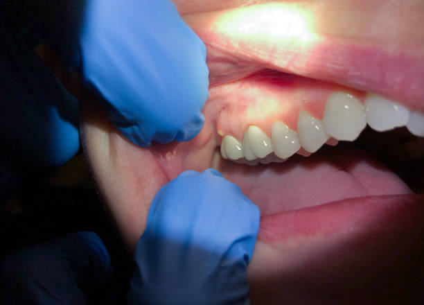 Best Emergency Treatment for Dental Infections or Abscesses in Greenwood Lake, NY